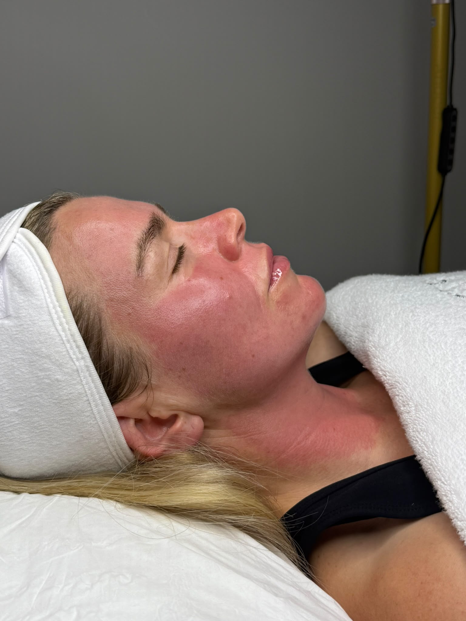 A client lying in profile on the couch in a white headband, straight after a skin treatment