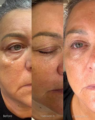 Three views of the same client's eye area, labelled before, 1 session in and 2 sessions in